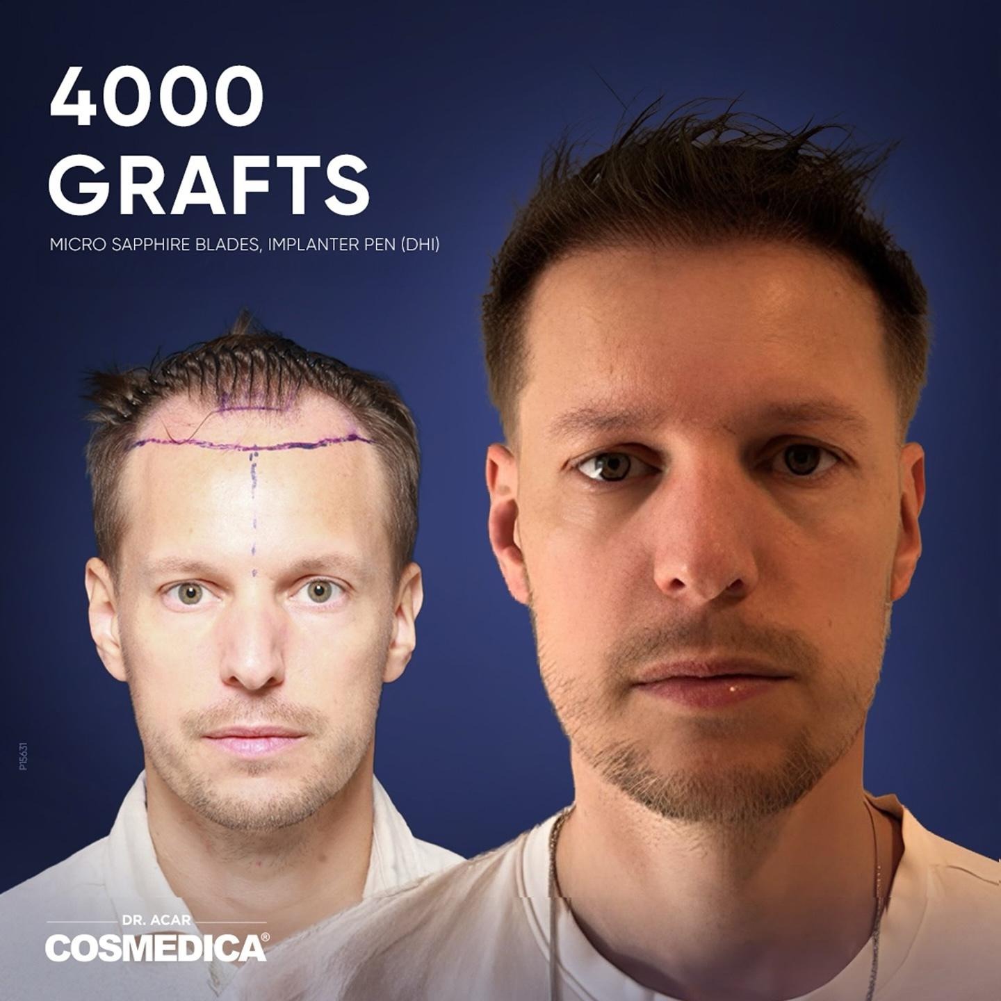 Before and after results of a 5300 grafts Micro Sapphire DHI hair transplant in Turkey.