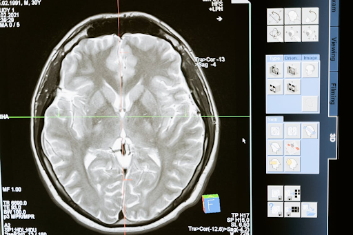 Vagus Nerve