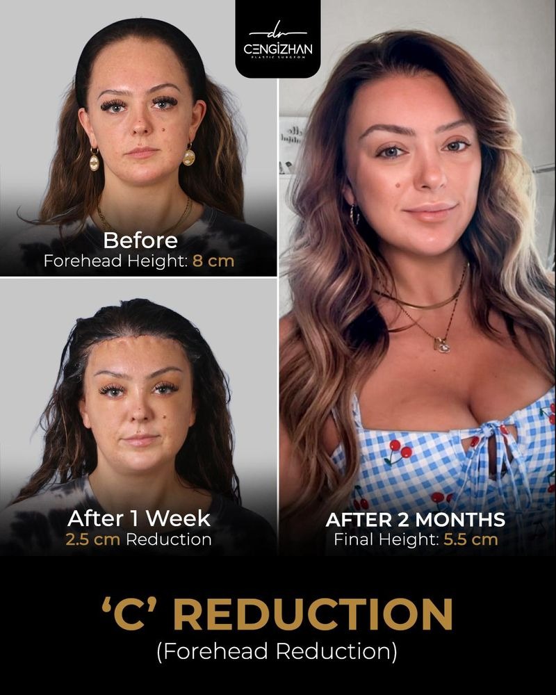 Forehead Reduction Surgery Before and After Results