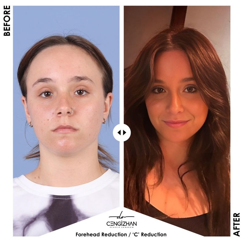 Forehead Reduction Surgery in Turkey