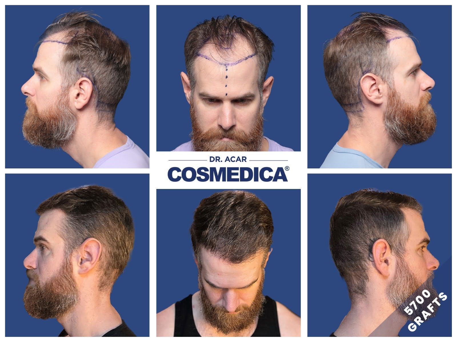 https://46156612.fs1.hubspotusercontent-na1.net/hubfs/46156612/Article%20Images/cosmedica%20hair%20transpalnt.jpg
